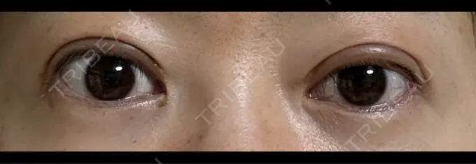 糸リフト / 脂肪吸引（顔） / 目尻切開 / 目元修正 / 輪郭修正 id（アイディ）美容外科 DAY 29 メイン用