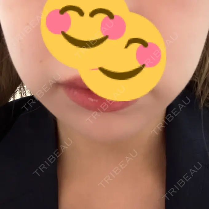 ボトックス（エラ・小顔） CLINIC W DAY 21 メイン用