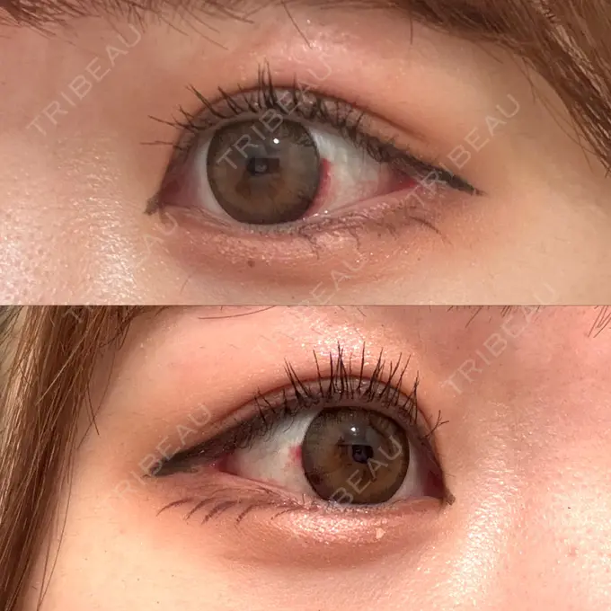 目尻切開 / 目尻靭帯移動 GLANZ CLINIC DAY 17 メイン用