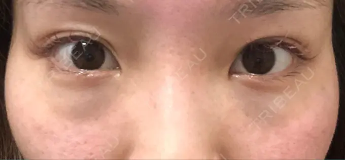 クマ治療 R Beauty CLINIC 名古屋院 DAY 1 メイン用