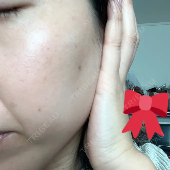 ピコスポット G MEDICAL ART クリニック 新宿院 AFTER メイン用