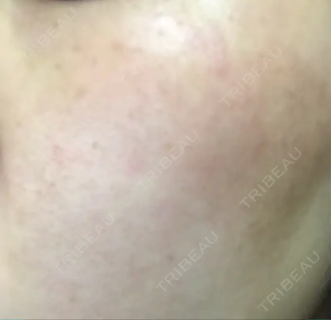 シミ取りレーザー 仁愛クリニック DAY 12 メイン用