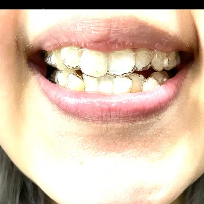 矯正（マウスピース） 東京銀座A CLINIC デンタル DAY 61 メイン用