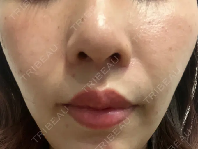 小鼻縮小（切開） / 人中短縮 / 鼻翼挙上 Otus Clinic 【オータスクリニック】 AFTER メイン用