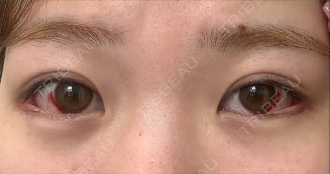 目尻切開 / 目尻靭帯移動 GLANZ CLINIC DAY 18 メイン用