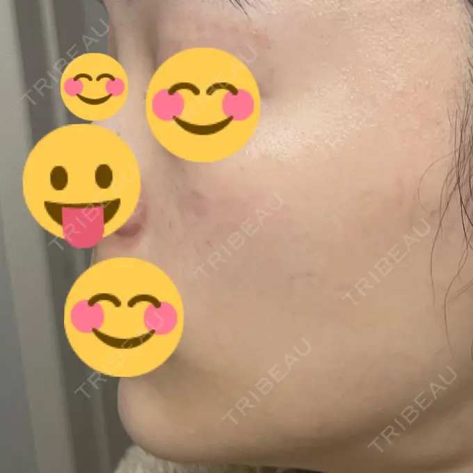 エレクトロポレーション / ルメッカ ゆきスキンクリニック 東池袋 DAY 2 メイン用