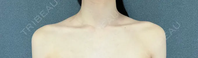 ボトックス（エラ・小顔） / ボトックス（肩） THE FIRST CLINIC 多摩センター院 DAY 38 メイン用