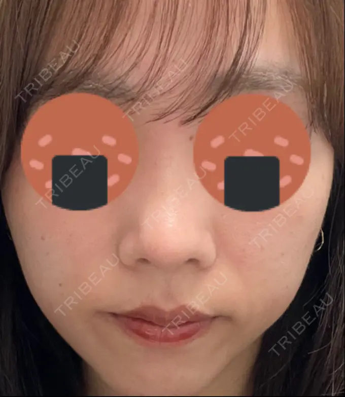 鼻尖形成（切開） / 軟骨移植 / 鼻尖縮小 / GLP-1ダイエット 東京シンデレラ美容外科 新宿院 AFTER メイン用