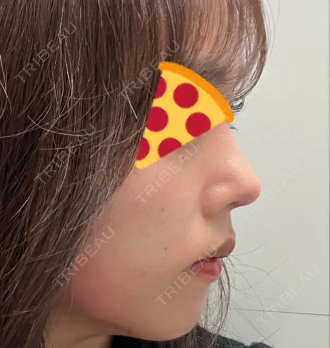 鼻尖形成（切開） / 軟骨移植 / 鼻尖縮小 / GLP-1ダイエット 東京シンデレラ美容外科 新宿院 DAY 25 メイン用