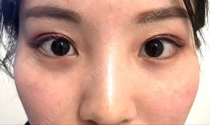 クマ治療 R Beauty CLINIC 名古屋院 AFTER メイン用