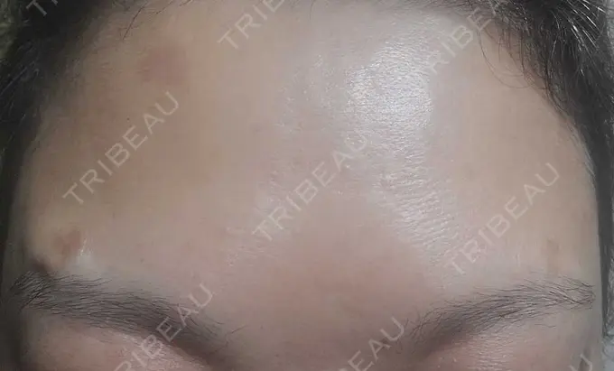 ボトックス（額） ルヴィクリニック イオンドーム前院 DAY 4 メイン用