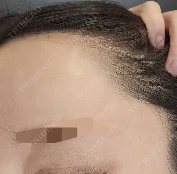 ニードルRF（ポテンツァなど） / ポテンツァ A CLINIC（エークリニック） 仙台院 DAY 23 メイン用