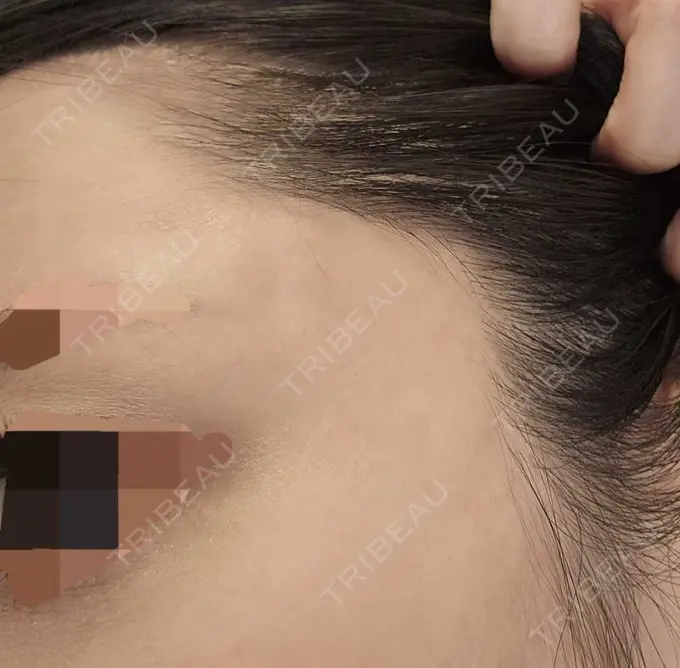 ニードルRF（ポテンツァなど） / ポテンツァ A CLINIC（エークリニック） 仙台院 DAY 23 メイン用