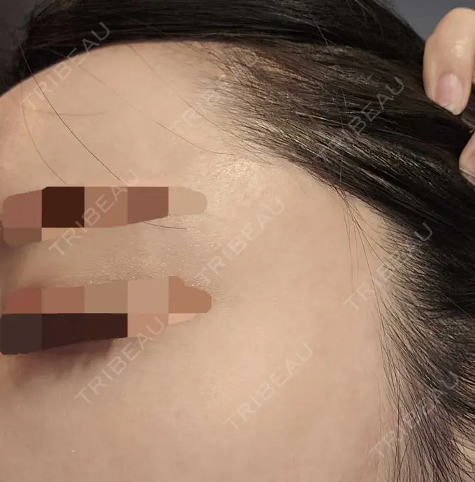 ニードルRF（ポテンツァなど） / ポテンツァ A CLINIC（エークリニック） 仙台院 AFTER メイン用