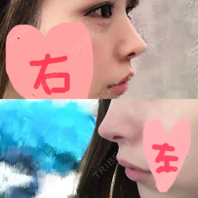 鼻尖形成（切開） / 鼻尖縮小 / その他（鼻） 高崎TAクリニック AFTER メイン用