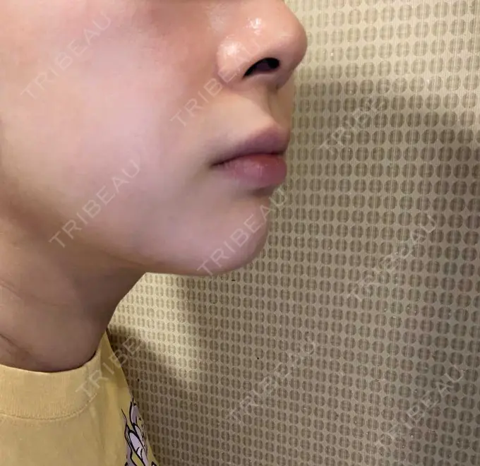 エレクトロポレーション / ルメッカ B-LINE CLINIC 池袋院 AFTER メイン用