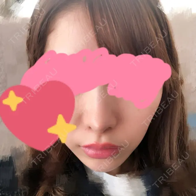 鼻尖形成（切開） / 鼻尖縮小 / その他（鼻） 高崎TAクリニック DAY 38 メイン用