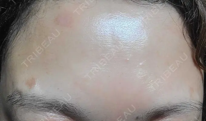 ボトックス（額） ルヴィクリニック イオンドーム前院 DAY 6 メイン用