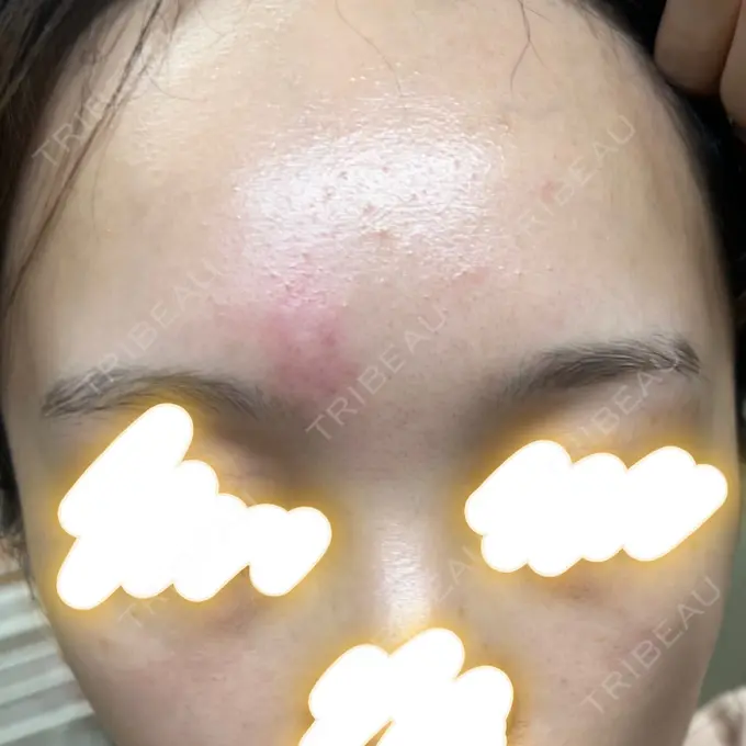 エレクトロポレーション / ルメッカ ゆきスキンクリニック 東池袋 DAY 7 メイン用