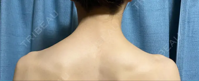 ボトックス（肩） 共立美容外科 名古屋院 DAY 14 メイン用