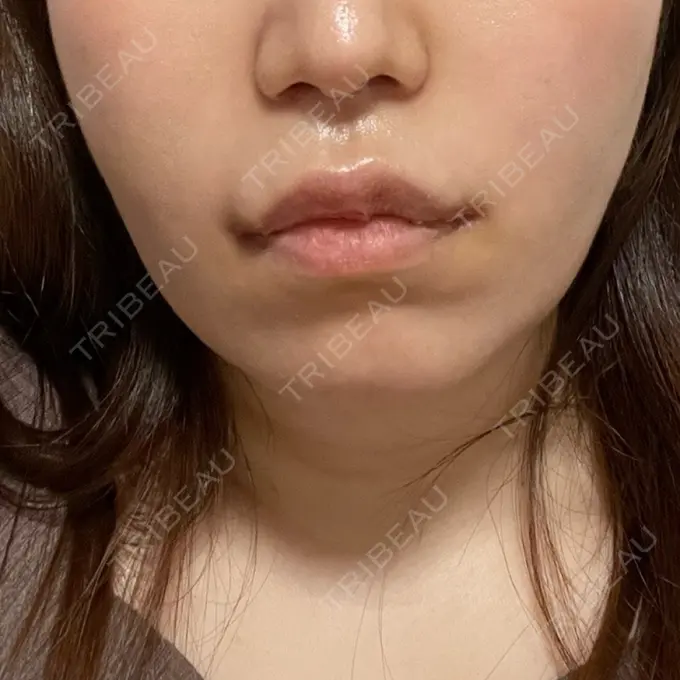 小鼻縮小（切開） / 糸リフト / 人中短縮 / 鼻翼挙上 / 口角挙上 / メーラーファット除去 / ボトックス（口角） Otus Clinic 【オータスクリニック】 DAY 10 メイン用