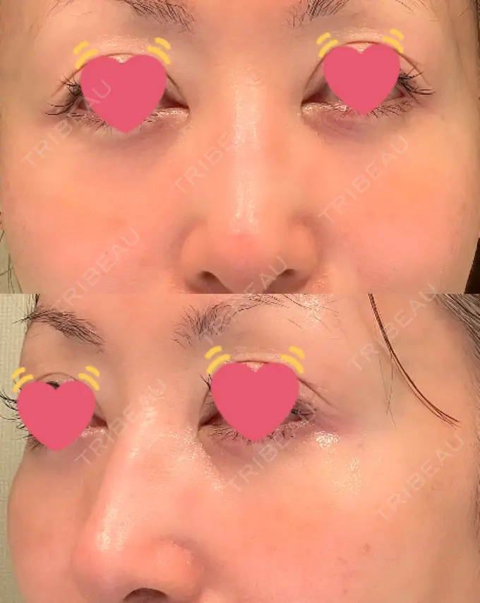 クマ治療 / 下まぶたたるみ取り / 脂肪注入（目の下） / ヒアルロン酸溶解 X CLINIC 大阪院 AFTER メイン用