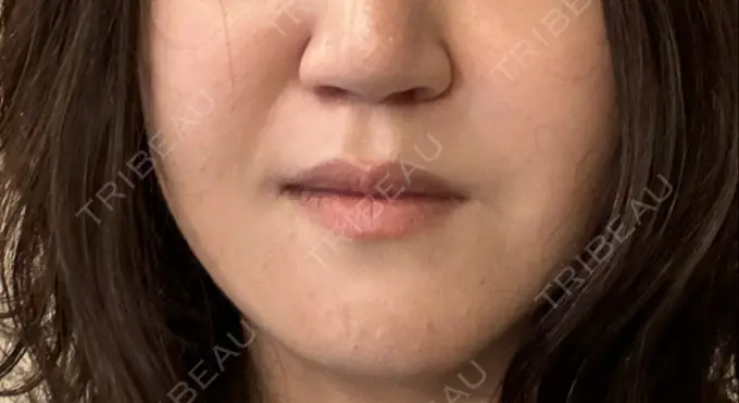 糸リフト / 脂肪吸引（顔） / 目尻切開 / 目元修正 / 輪郭修正 id（アイディ）美容外科 AFTER メイン用