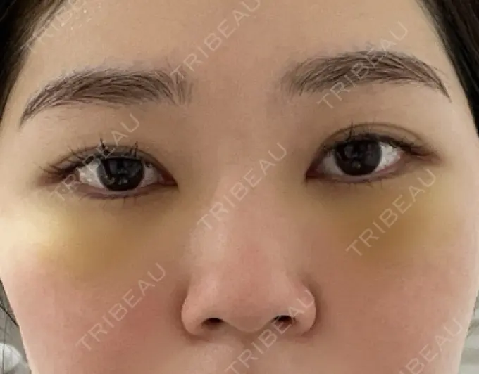 クマ治療 / 脂肪注入（目の下） 吉井クリニック DAY 3 メイン用