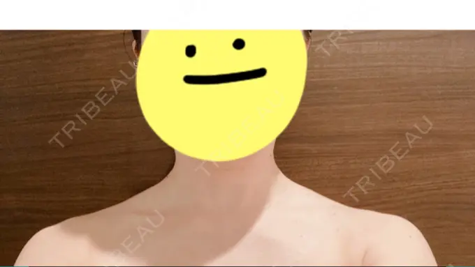 ボトックス（肩） 共立美容外科 京都院 AFTER メイン用