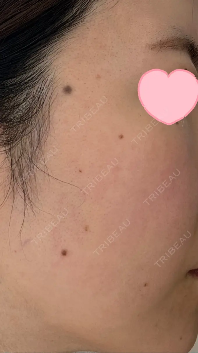 ルメッカ ルラ美容クリニック 高田馬場院 DAY 0 メイン用