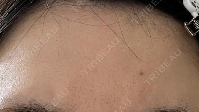 ルメッカ ルラ美容クリニック 高田馬場院 DAY 0 メイン用