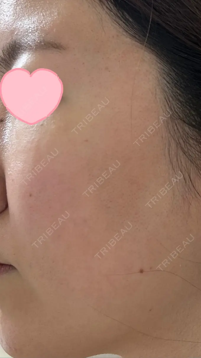 ルメッカ ルラ美容クリニック 高田馬場院 DAY 0 メイン用