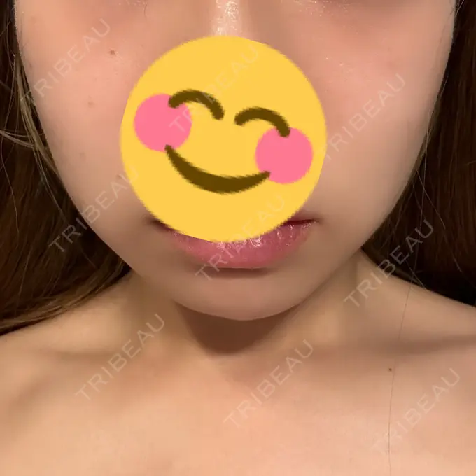 ボトックス（エラ・小顔） CLINIC W DAY 23 メイン用