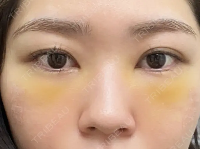 クマ治療 / 脂肪注入（目の下） 吉井クリニック DAY 4 メイン用