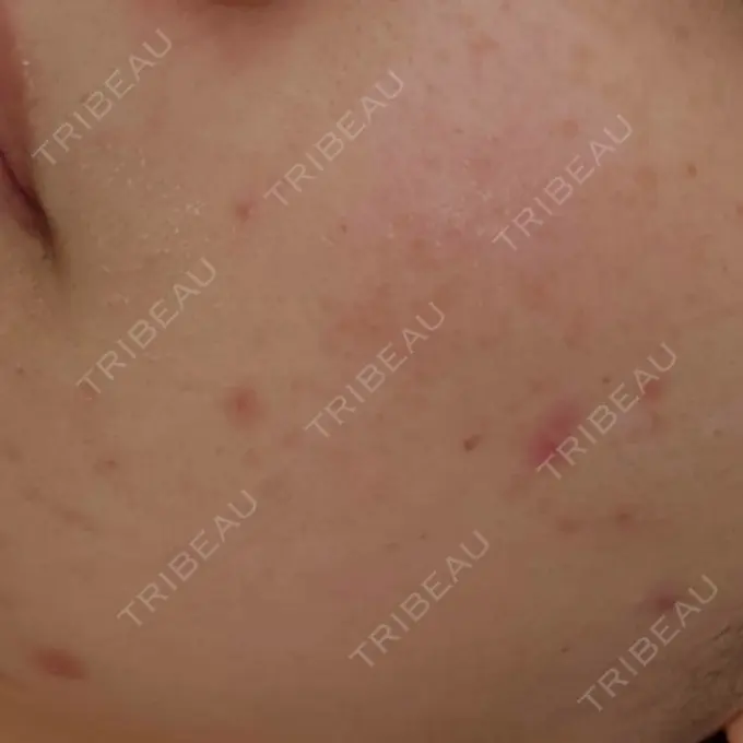 ピーリング（ニキビ・毛穴） / イオン導入 渋谷美容外科クリニック 渋谷院 DAY 0 メイン用