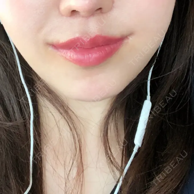 人中短縮 / 口唇縮小術 / 口角挙上 HB整形外科 DAY 24 メイン用