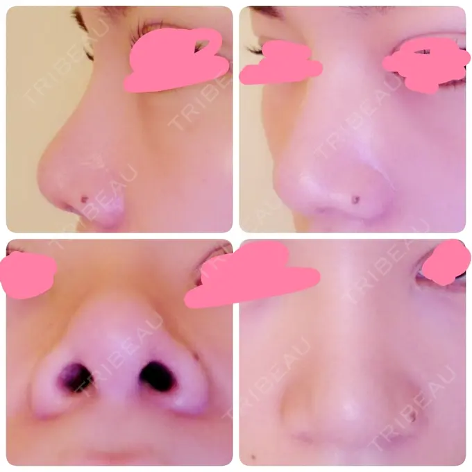 隆鼻術 / 鼻尖形成（切開） / 鼻尖縮小 ヤスミクリニック DAY 15 メイン用