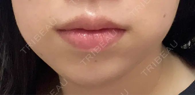 ハイフ（顔） ミニマムスキンクリニック池袋 AFTER メイン用