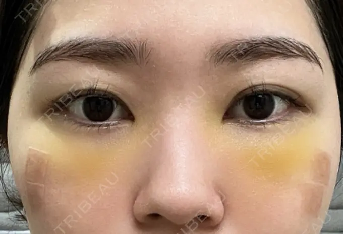 クマ治療 / 脂肪注入（目の下） 吉井クリニック DAY 5 メイン用