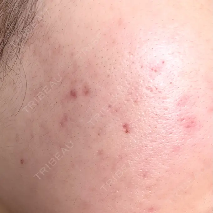 毛穴洗浄（ハイドラフェイシャルなど） / 光治療（フォトフェイシャルなど） ミニマムスキンクリニック池袋 AFTER メイン用