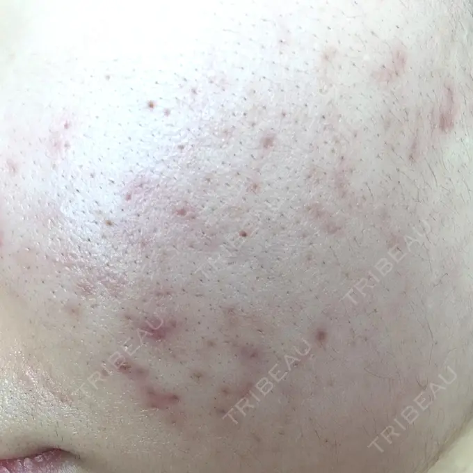 毛穴洗浄（ハイドラフェイシャルなど） / 光治療（フォトフェイシャルなど） ミニマムスキンクリニック池袋 DAY 11 メイン用