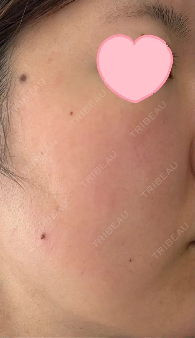 ルメッカ ルラ美容クリニック 高田馬場院 DAY 2 メイン用