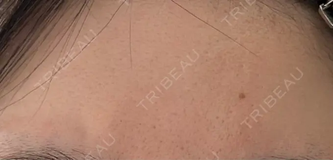 ルメッカ ルラ美容クリニック 高田馬場院 DAY 2 メイン用