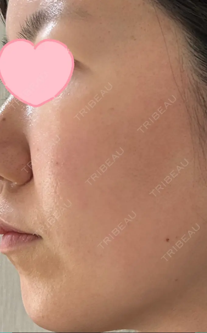 ルメッカ ルラ美容クリニック 高田馬場院 DAY 2 メイン用