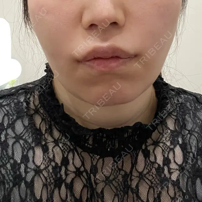 小鼻縮小（切開） / 糸リフト / 人中短縮 / 鼻翼挙上 / 口角挙上 / メーラーファット除去 / ボトックス（口角） Otus Clinic 【オータスクリニック】 DAY 15 メイン用