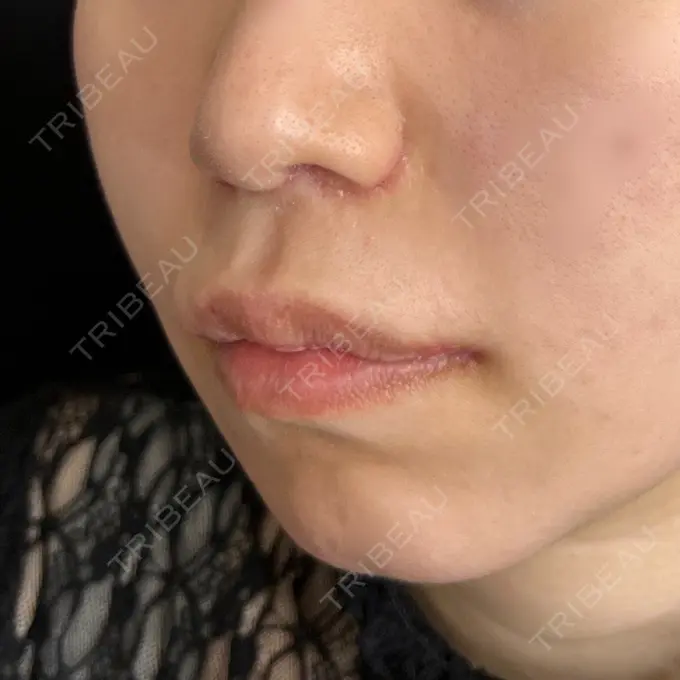 小鼻縮小（切開） / 糸リフト / 人中短縮 / 鼻翼挙上 / 口角挙上 / メーラーファット除去 / ボトックス（口角） Otus Clinic 【オータスクリニック】 DAY 15 メイン用