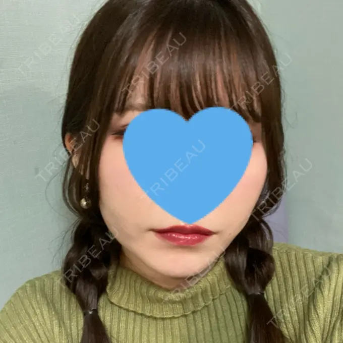 脂肪吸引（顔） / ボトックス（エラ・小顔） Otus Clinic 【オータスクリニック】 DAY 31 メイン用