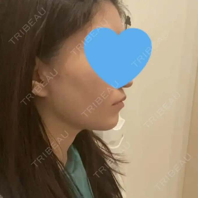 脂肪吸引（顔） / ボトックス（エラ・小顔） Otus Clinic 【オータスクリニック】 DAY 96 メイン用