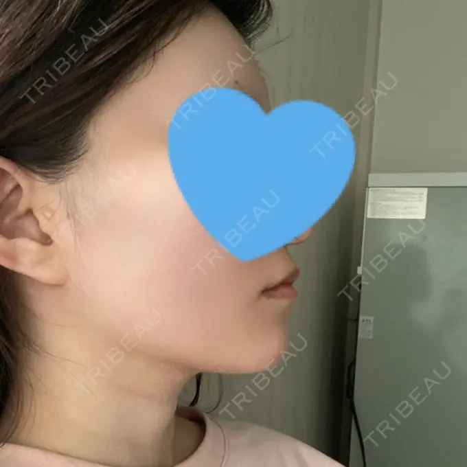 脂肪吸引（顔） / ボトックス（エラ・小顔） Otus Clinic 【オータスクリニック】 AFTER メイン用