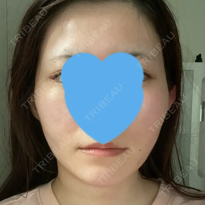 脂肪吸引（顔） / ボトックス（エラ・小顔） Otus Clinic 【オータスクリニック】 DAY 147 メイン用